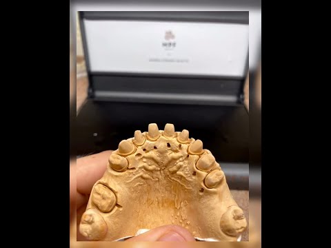 Видео: Feldspathic Crowns on refractory керамика зубной техник Техника нанесения dental technician technik