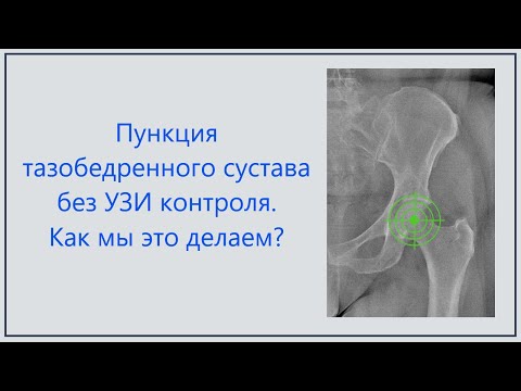 Видео: пункция тазобедренного сустава
