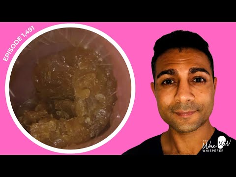 Видео: 1,491 — Удаление ушной серы с помощью новых инструментов Rai Cerumen