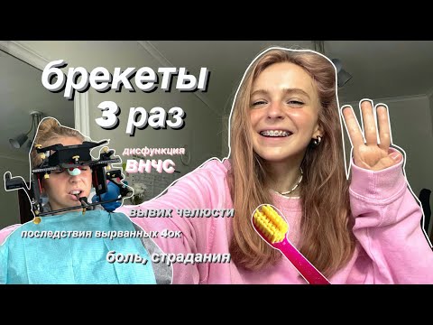 Видео: брекеты моя история // 3 раз ношу брекеты // дисфункция височно-нижнечелюстного сустава / установка