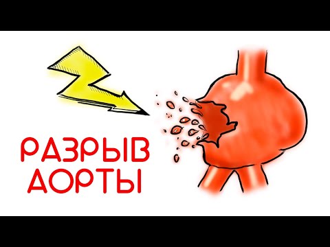 Видео: Разрыв аорты = смерть? // Доктор Ху