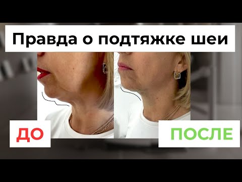 Видео: Как НАВСЕГДА избавиться от второго подбородка? Реально рабочие методики.