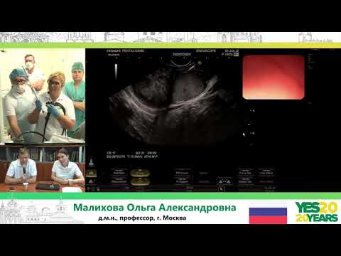 Видео: 21. ЭУС: ГИСО, опухоль поджелудочной железы. О. А. Малихова