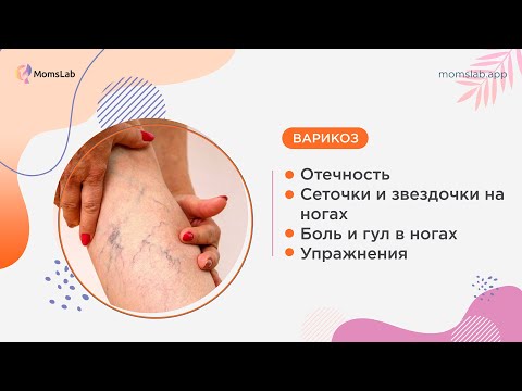 Видео: Варикозная болезнь у женщин: симптомы и причины. Упражнения для лечения в домашних условиях