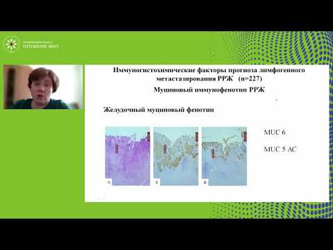 Видео: Морфологические и иммуногистохимические факторы лимфогенного метастазирования раннего рака желудка