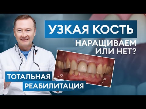 Видео: НАРАЩИВАЕМ или нет  УЗКАЯ КОСТЬ, ТОТАЛЬНАЯ реабилитация / Клинический разбор