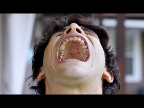 Видео: Обновление данных о лечении после удаления MSE