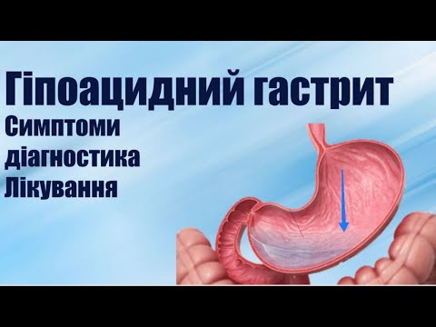 Видео: Гіпоацидний гастрит симптоми, причини, дієта, лікування препаратами і методами народної медицини