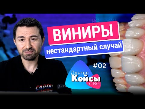 Видео: Керамические виниры и композитные реставрации. Дентал Кейсы от BG. #02