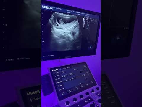 Видео: 10 апталық жүктілік, қалай дамиды? Ойнап жатқанын көресіз  #10аптажүктілік