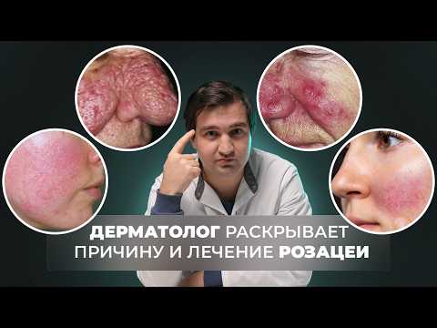 Видео: Почему лицо краснеет после душа или вина? Все о розацеа