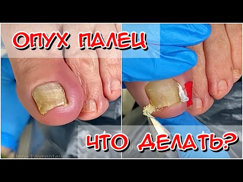 Видео: Опух палец что делать? Болит палец / Вросший ноготь