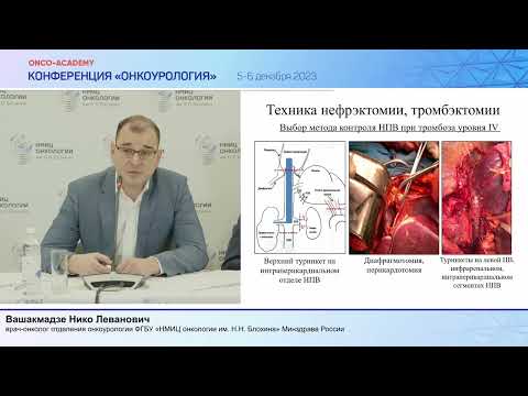 Видео: Техника тромбэктомии при раке почки с опухолевым венозным тромбозом III-IV уровня. Вашакмадзе Н. Л.
