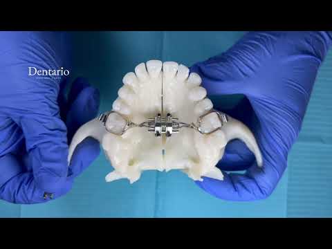 Видео: Как правильно крутить аппарат MSE II ? | Инструкция от стоматологии Dentario