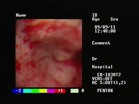 Видео: Павел Пульняшенко: инородное тело пищевода, последствия