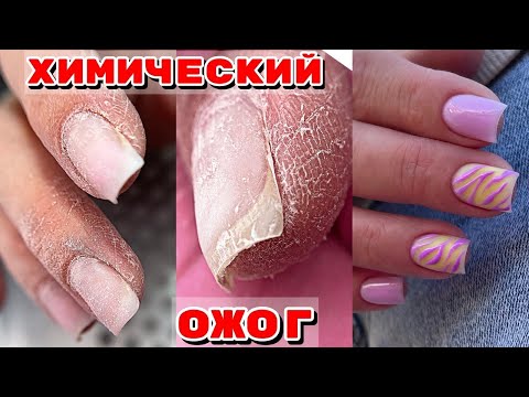 Видео: ХИМИЧЕСКИЙ ОЖОГ 😐 Трещины на коже 💅 Сложные руки 💅 Маникюр