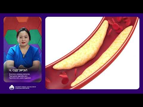 Видео: Атеросклероз өвчин гэж юу вэ?
