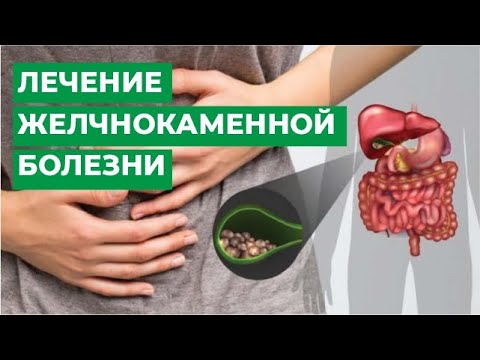 Видео: Лечение желчнокаменной болезни