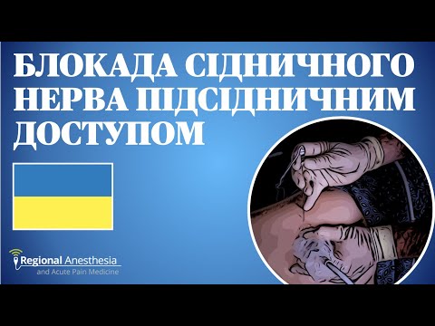 Видео: БЛОКАДА СІДНИЧНОГОНЕРВА ПІДСІДНИЧНИМДОСТУПОМ 🇺🇦 (Subgluteal Sciatic Nerve Block)