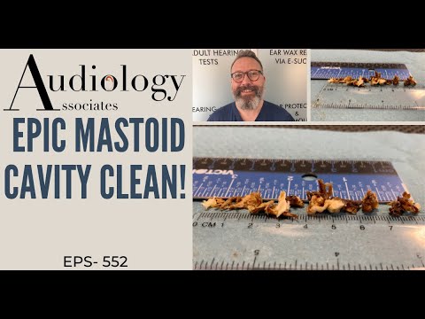 Видео: Эпическое очищение сосцевидной полости - EP552