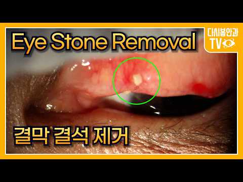 Видео: Удаление глазных камней