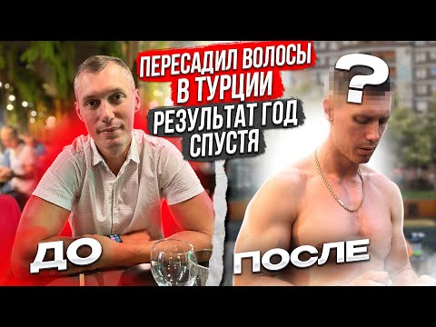 Видео: ПЕРЕСАДКА ВОЛОС В ТУРЦИИ, что со мной сделали!? Результат через год!