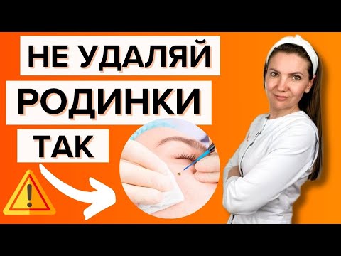 Видео: РАК после удаления родинки. МИФ или опасная реальность (ответ дерматолога)
