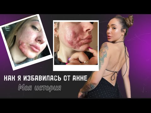 Видео: Как я избавилась от  акне | МОЯ ИСТОРИЯ