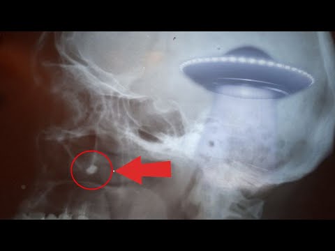 Видео: Импланты внеземного происхождения - случай В.И.Карася