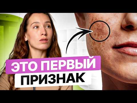 Видео: Почему появляются ПИГМЕНТНЫЕ ПЯТНА и как от них избавиться?