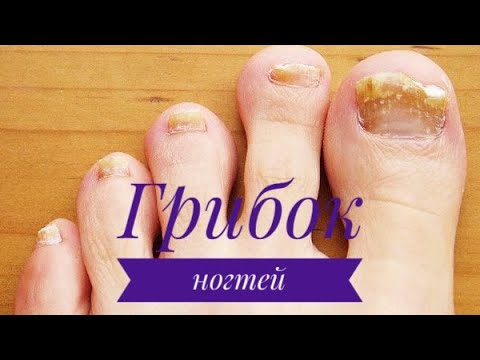 Видео: ГРИБОК НОГТЕЙ. Лечение грибка ногтей: почему средства от грибка на ногтях не помогают?