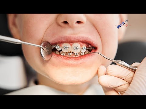 Видео: Ортодонтско лечение при деца