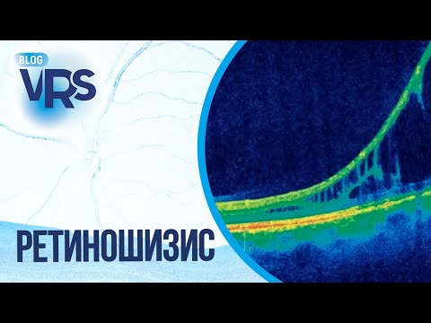 Видео: Ретиношизис, мнение иностранных коллег