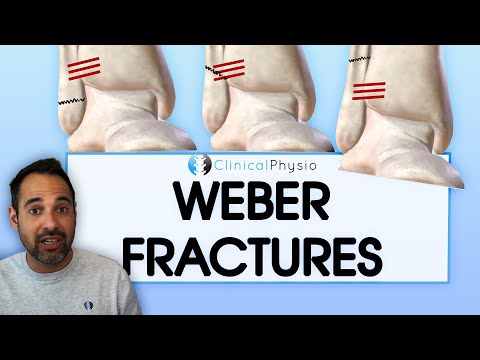 Видео: Что такое перелом лодыжки Вебера? | Что это такое, что нужно знать и как лечить!