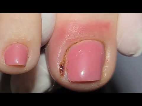 Видео: БЕДНАЯ ДЕВОЧКА!😰ЕЕ НОГОТЬ СИЛЬНО ВРОС (с субтитрами)