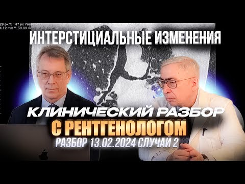Видео: Клинические разборы с рентгенологом. Профессор Тюрин. Интерстициальные изменения. 13.02.2024 2 кейс