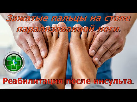 Видео: Зажатые пальцы на парализованной ноге. Массаж упражнения. Реабилитация после инсульта.