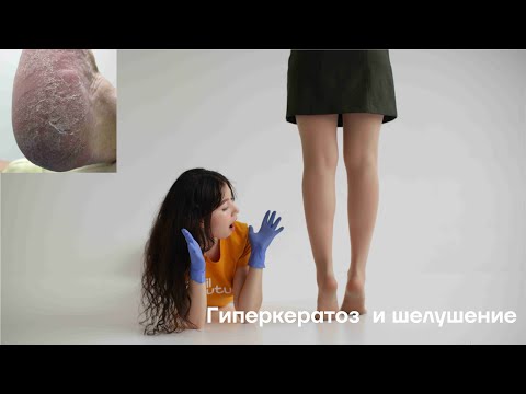 Видео: Гиперкератоз  и шелушение. О чем говорит наша кожа?