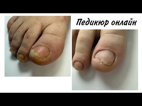 Видео: Аппаратный педикюрю. Мозоль🤯