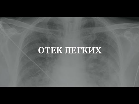 Видео: Отек Легких - Этиология, Патогенез, Классификация, Клиника, Диагностика, Лечение / Терапия