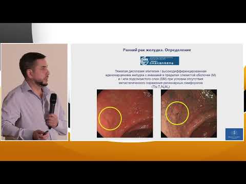 Видео: 4. Павлов П.В. Диагностика и лечение раннего рака желудка