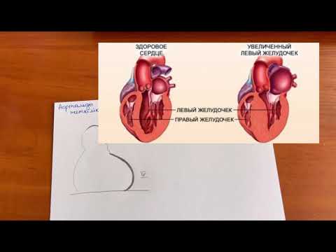 Видео: Қолқаның және митральды қақпақшалардың жеткіліксіздігі мен стенозы. Рентгенді оңай түсініп ал!