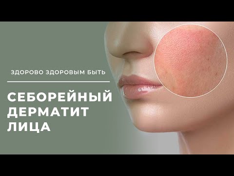 Видео: Себорейный дерматит лица