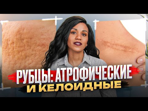 Видео: РУБЦЫ: решаем проблему радикально // Рубцы после пластики, косметологии, травм: чем и как лечить?