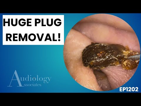 Видео: Экстремальное удаление ушной серы | Глиноподобная пробка и ручное извлечение — EP1202