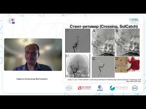 Видео: Тромбэктомия у больных инсультом. д.м.н., проф. Савелло А.В.