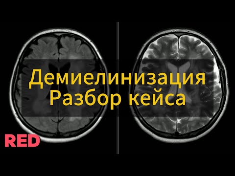 Видео: Разбор кейса демиелинизации
