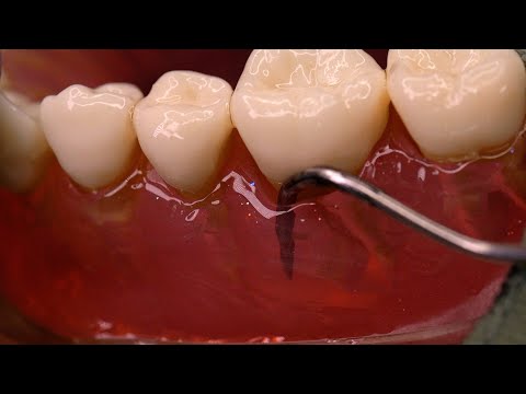 Видео: ASMR Ролевая игра стоматолога с покалыванием в деснах (без разговоров, удаление зубного камня, ACMP)