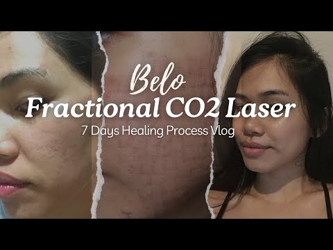 Видео: Процесс лечения фракционным CO2-лазером BELO | ДЕЙСТВИТЕЛЬНО ЛИ ЭТО РАБОТАЕТ? (чего ожидать и ско...