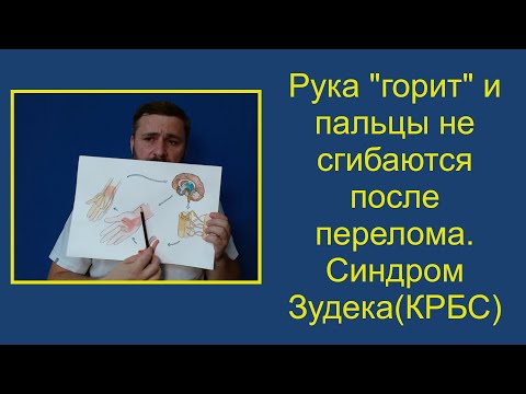 Видео: Рука "горит",пальцы не сгибаются после перелома.Особенности реабилитации при синдроме Зудека (КРБС).